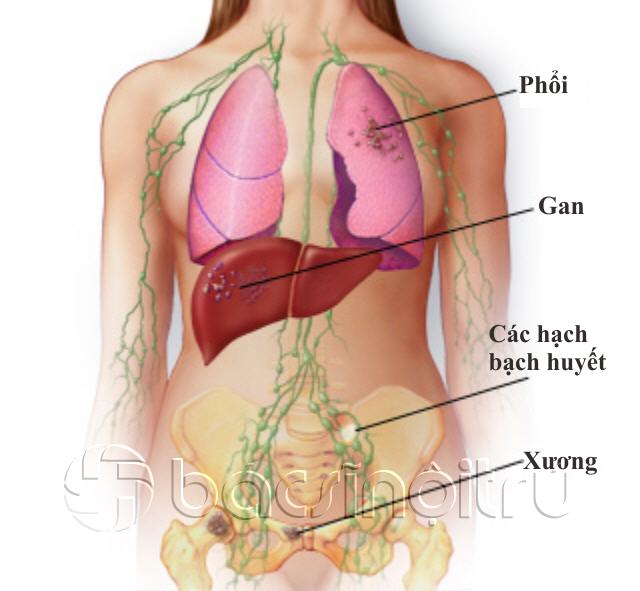 Các giai đoạn của ung thư vú